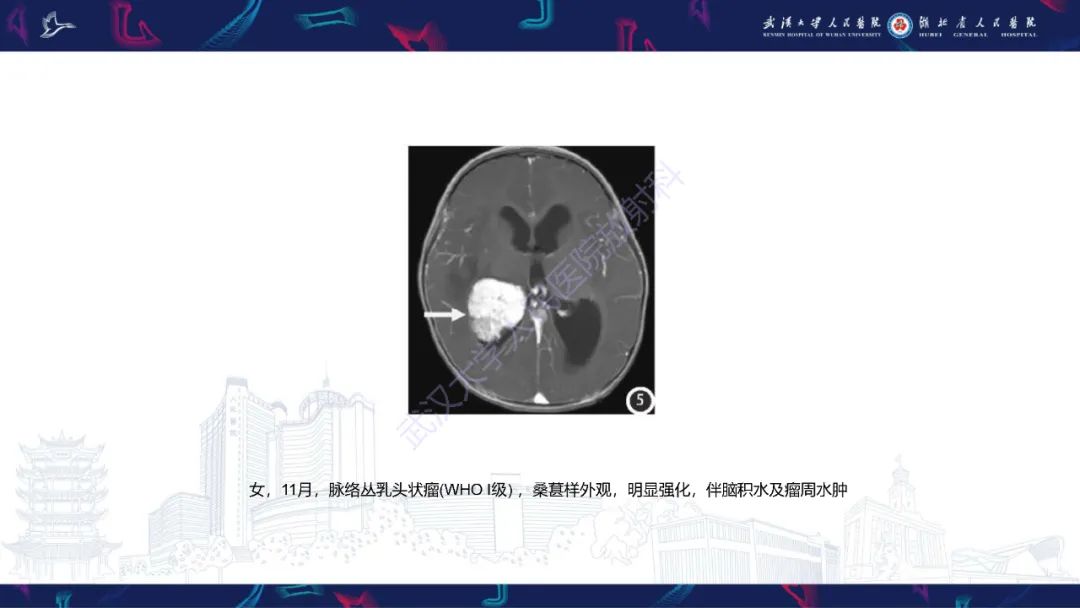 【PPT】侧脑室肿瘤影像诊断-25