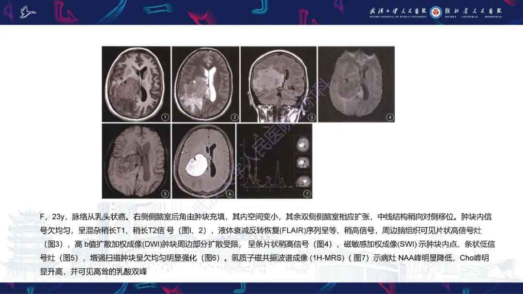 【PPT】侧脑室肿瘤影像诊断-26