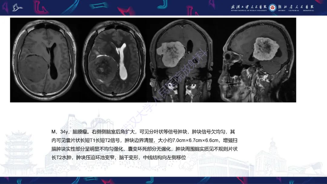 【PPT】侧脑室肿瘤影像诊断-28