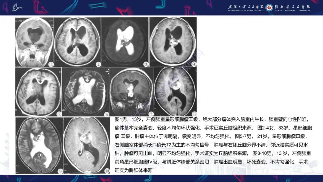 【PPT】侧脑室肿瘤影像诊断-30