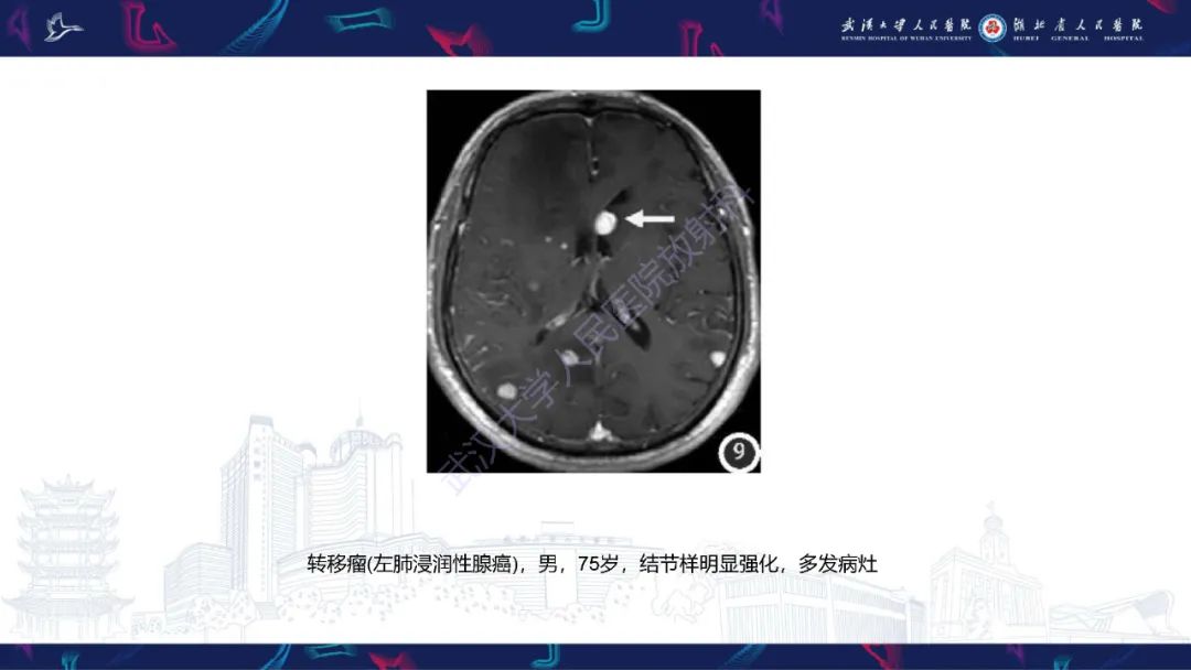 【PPT】侧脑室肿瘤影像诊断-32