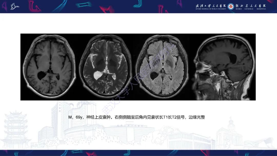 【PPT】侧脑室肿瘤影像诊断-35