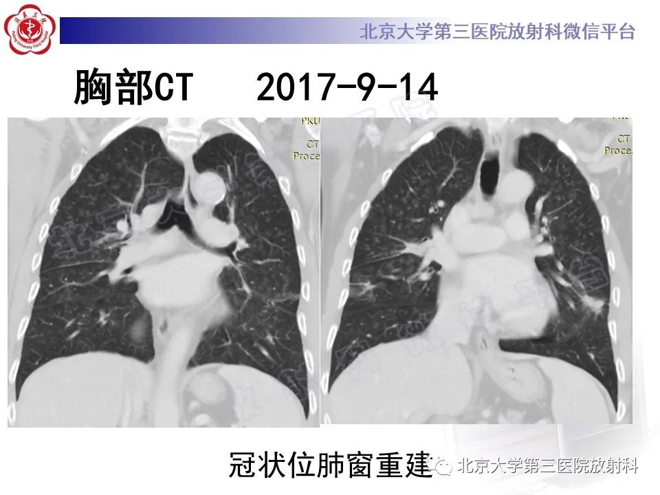 【PPT】过敏性肺炎-7