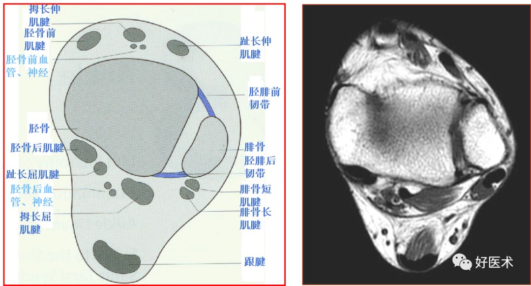 踝关节MRI解剖与常见病变-6