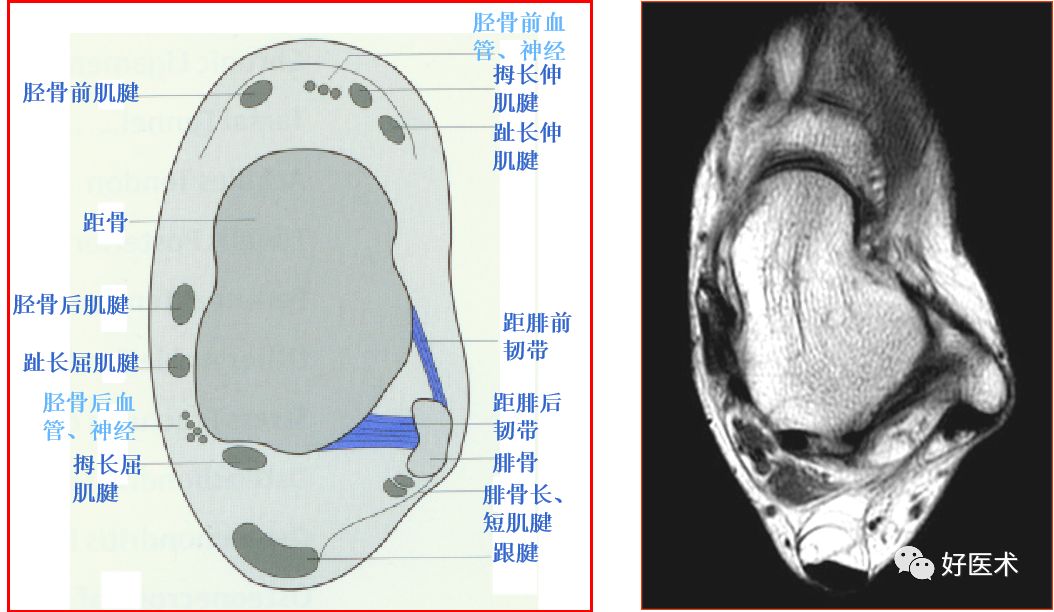 踝关节MRI解剖与常见病变-7