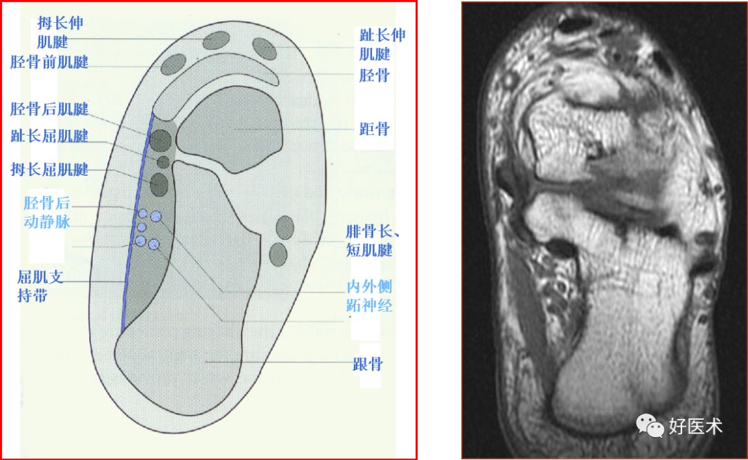 踝关节MRI解剖与常见病变-8