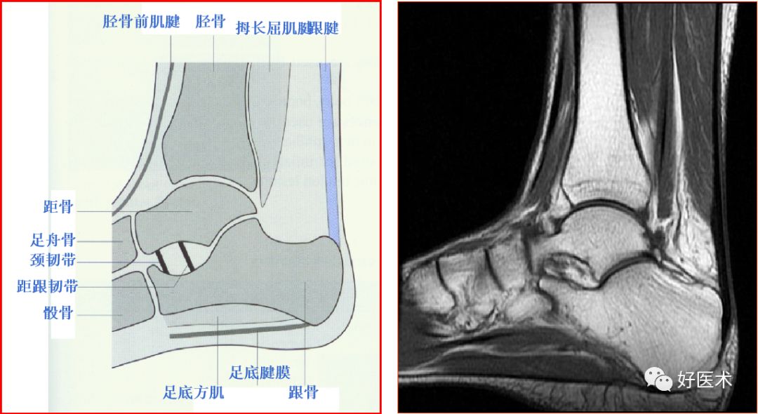踝关节MRI解剖与常见病变-9