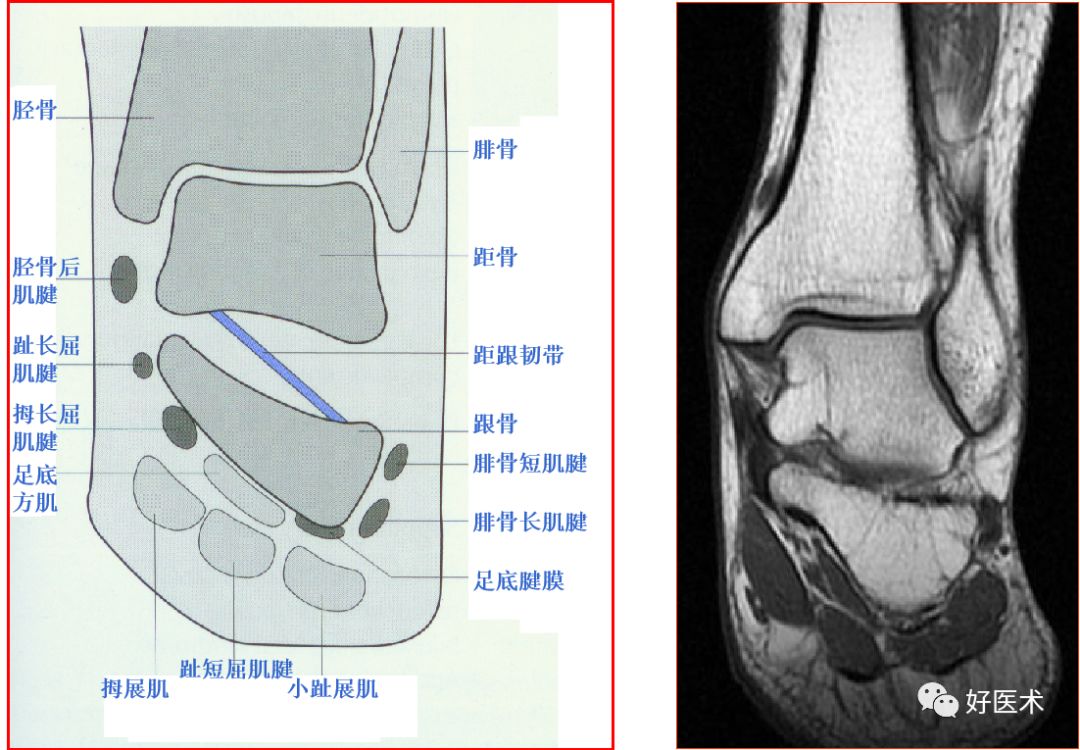 踝关节MRI解剖与常见病变-10