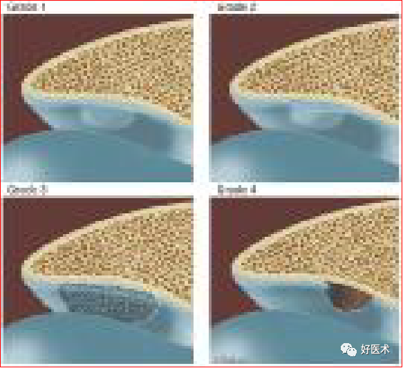 踝关节MRI解剖与常见病变-12