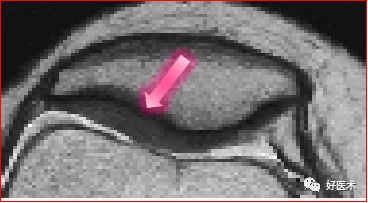 踝关节MRI解剖与常见病变-13