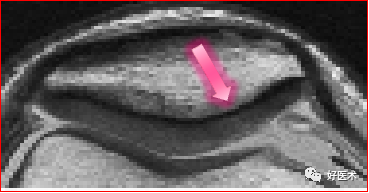 踝关节MRI解剖与常见病变-14