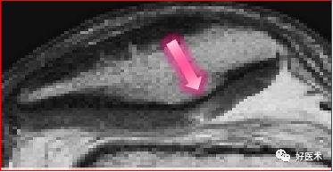 踝关节MRI解剖与常见病变-15