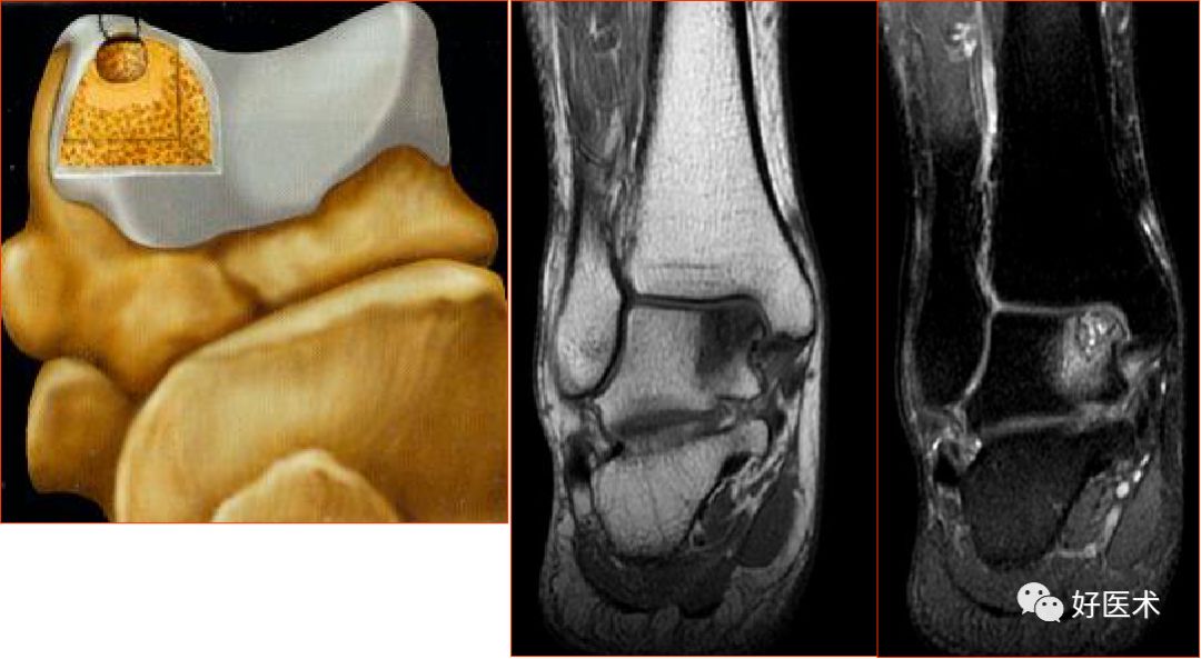 踝关节MRI解剖与常见病变-17