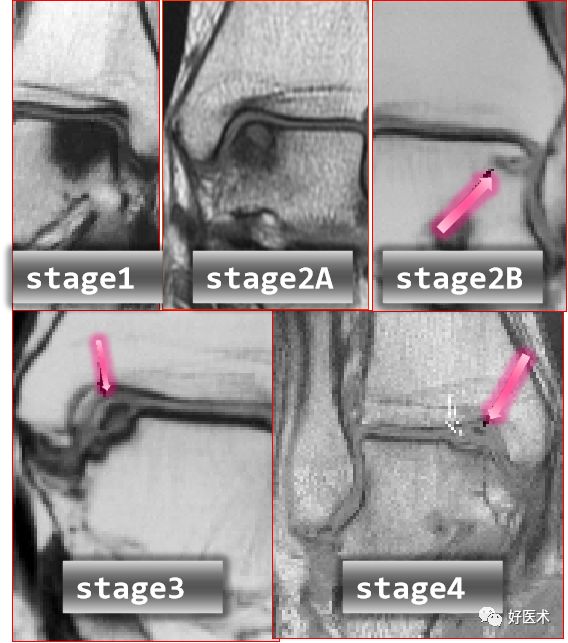 踝关节MRI解剖与常见病变-18