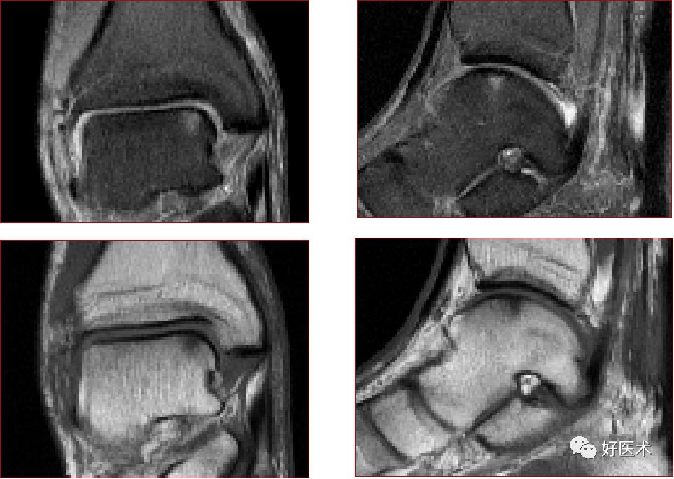 踝关节MRI解剖与常见病变-19