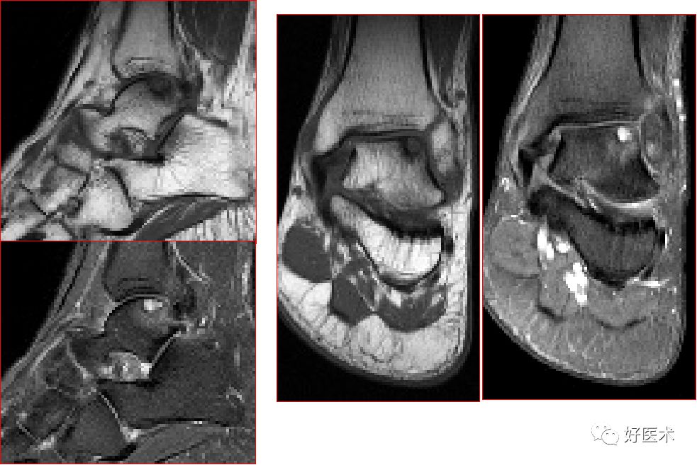 踝关节MRI解剖与常见病变-21