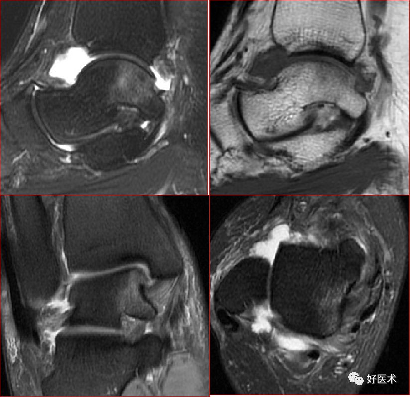 踝关节MRI解剖与常见病变-20