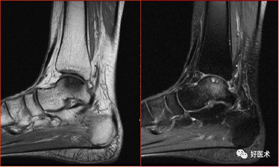 踝关节MRI解剖与常见病变-22