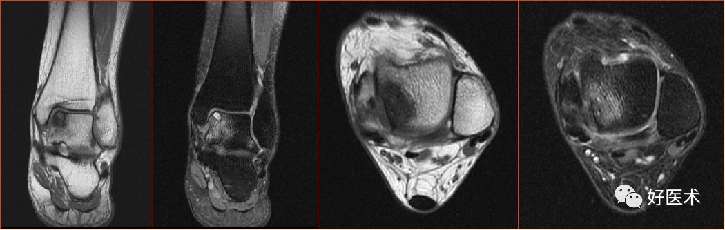 踝关节MRI解剖与常见病变-23