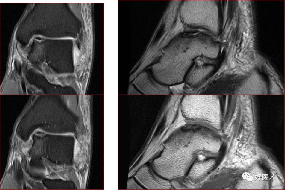 踝关节MRI解剖与常见病变-24
