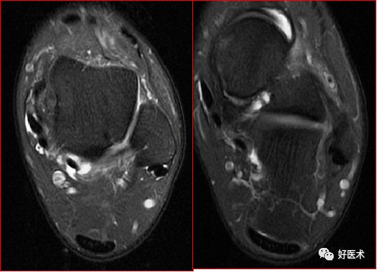 踝关节MRI解剖与常见病变-25