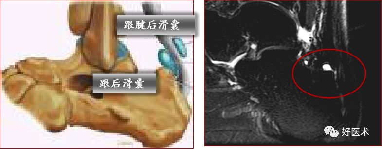 踝关节MRI解剖与常见病变-27