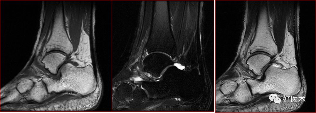 踝关节MRI解剖与常见病变-26