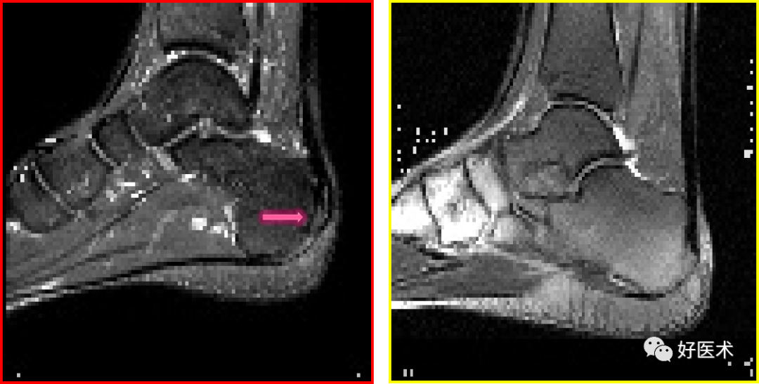 踝关节MRI解剖与常见病变-28