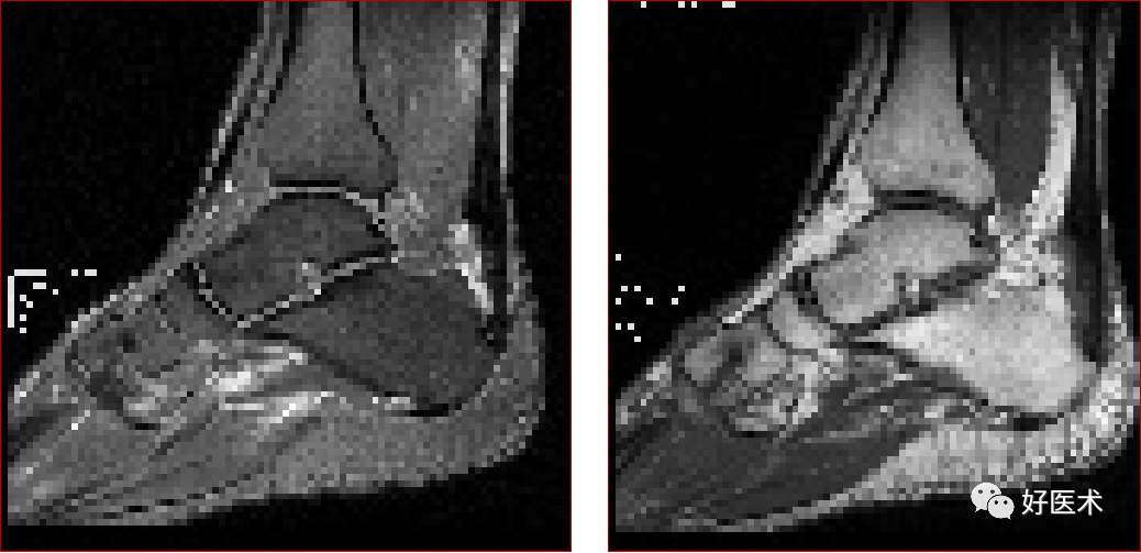 踝关节MRI解剖与常见病变-30