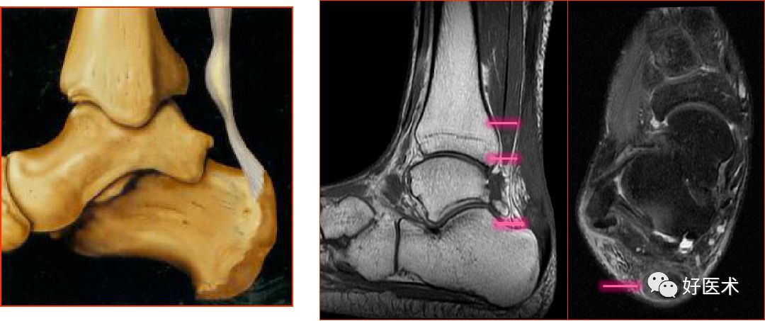 踝关节MRI解剖与常见病变-29