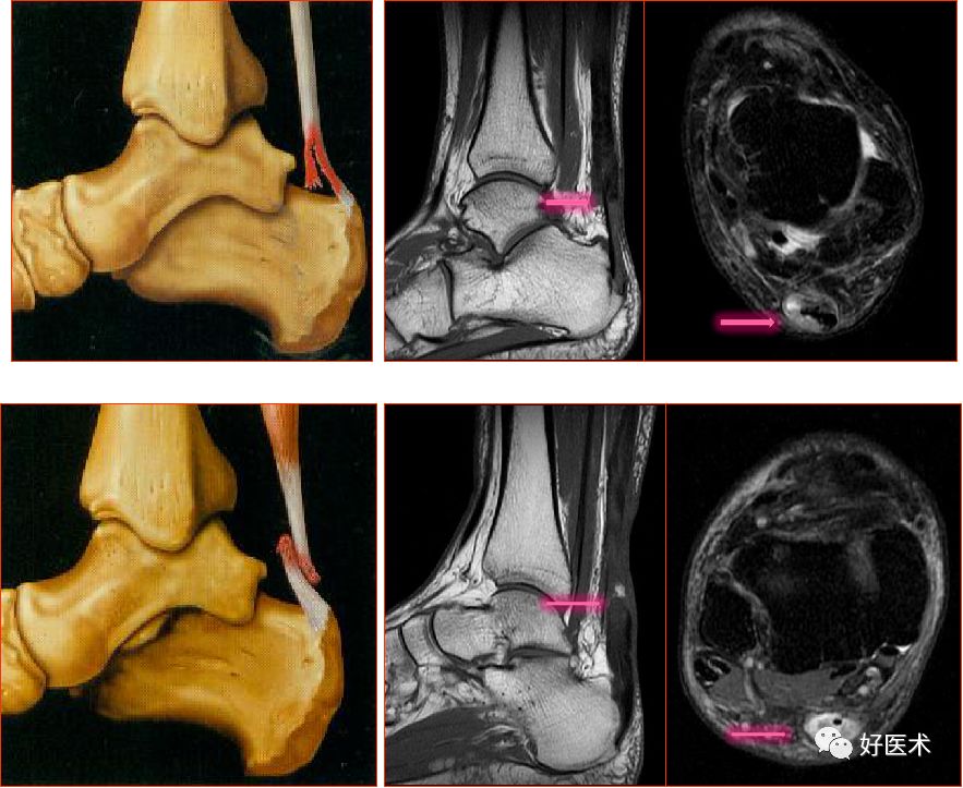 踝关节MRI解剖与常见病变-31