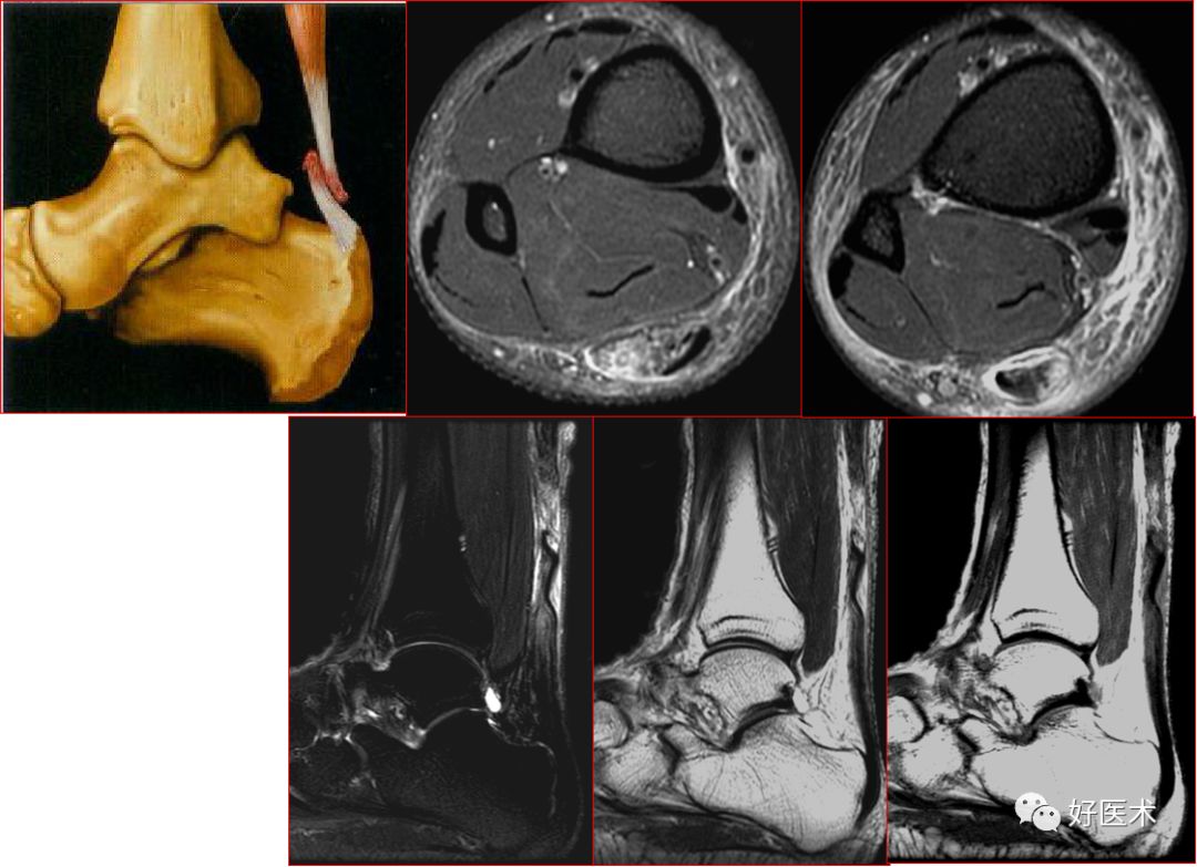 踝关节MRI解剖与常见病变-32