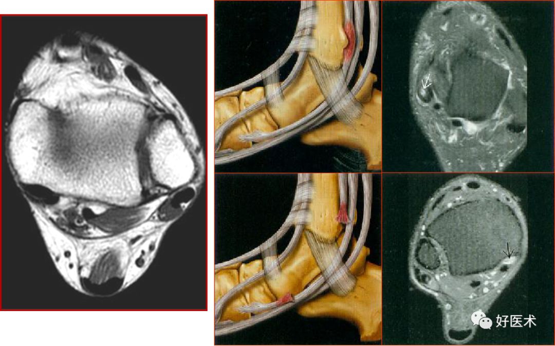 踝关节MRI解剖与常见病变-33
