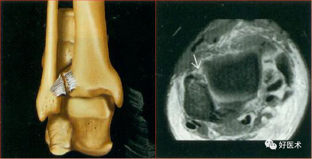 踝关节MRI解剖与常见病变-35
