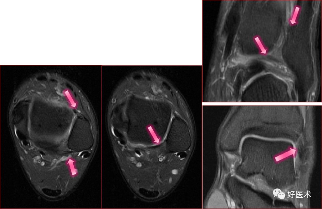 踝关节MRI解剖与常见病变-34