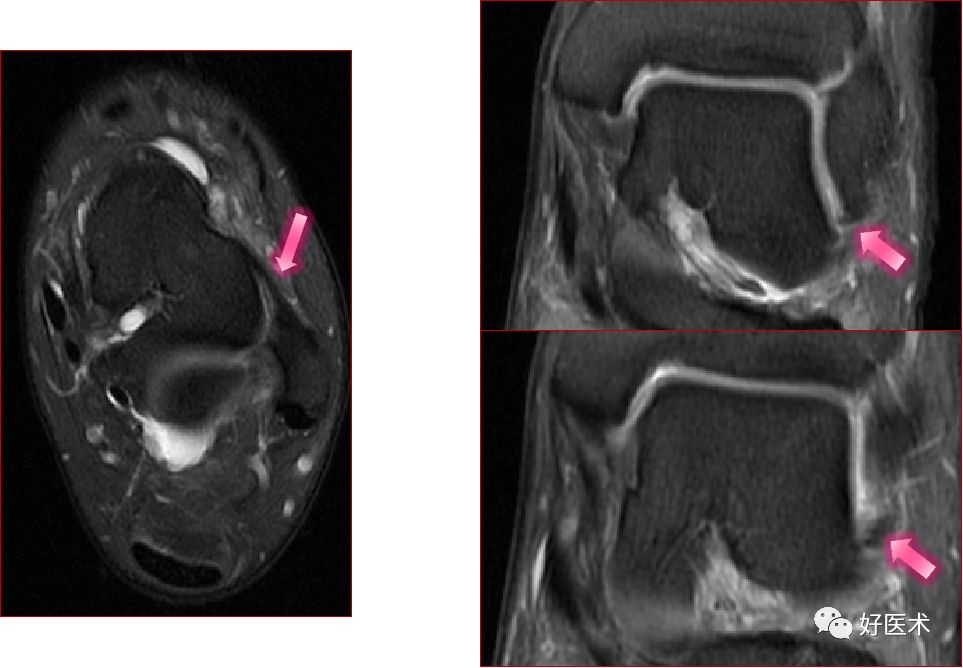 踝关节MRI解剖与常见病变-36