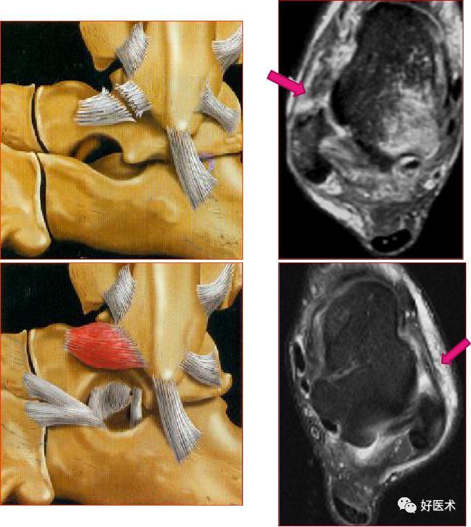 踝关节MRI解剖与常见病变-37