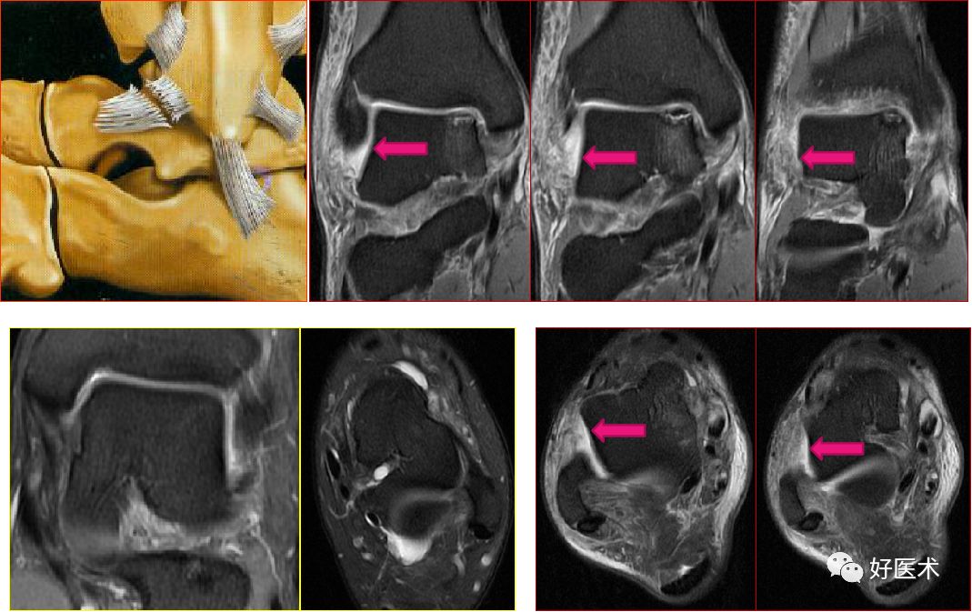 踝关节MRI解剖与常见病变-38