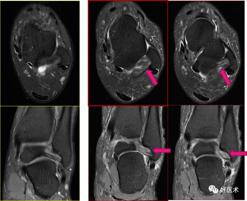 踝关节MRI解剖与常见病变-40