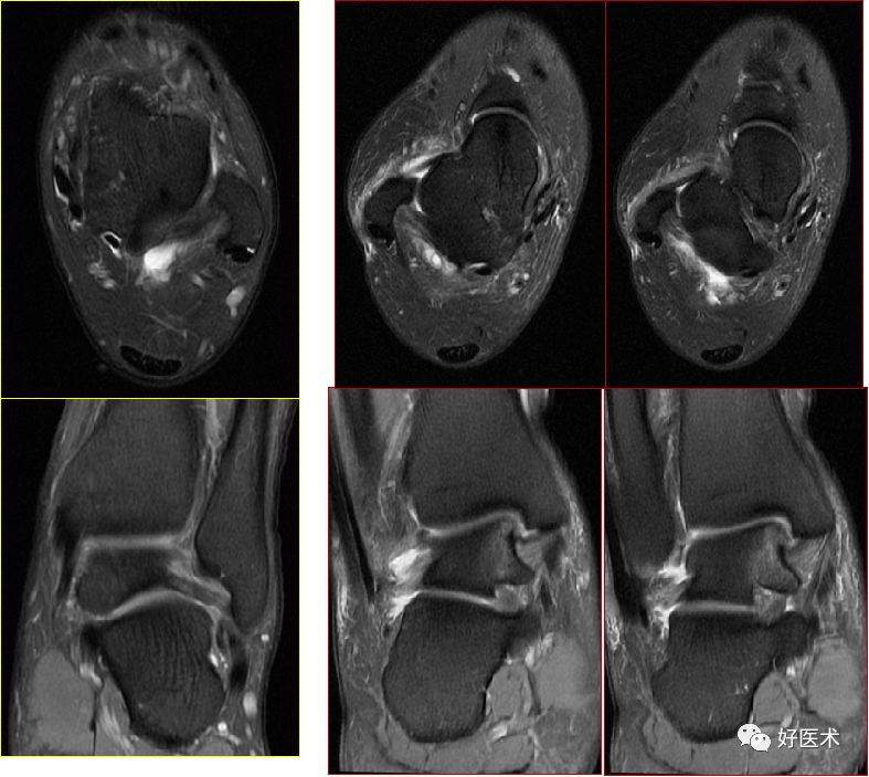 踝关节MRI解剖与常见病变-41