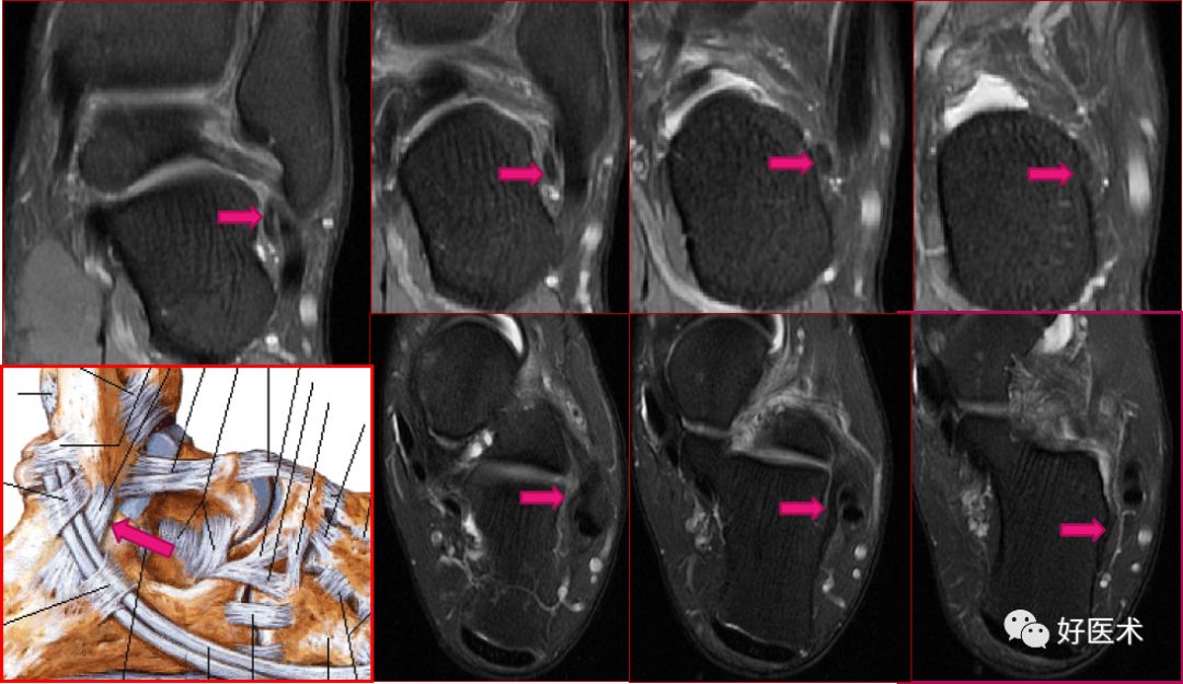踝关节MRI解剖与常见病变-42