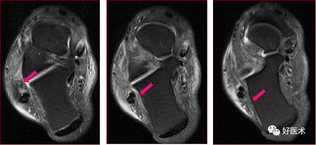 踝关节MRI解剖与常见病变-43