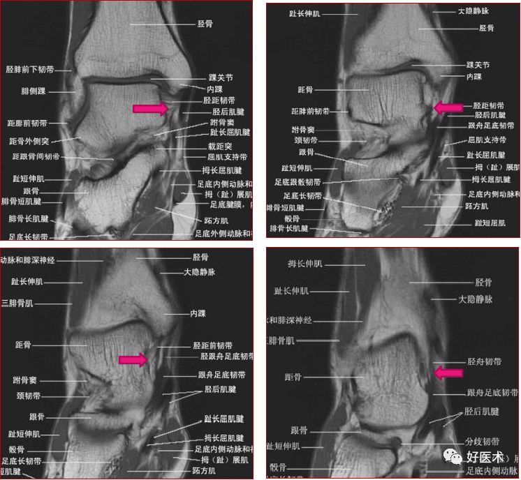 踝关节MRI解剖与常见病变-45