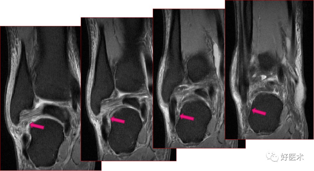 踝关节MRI解剖与常见病变-44