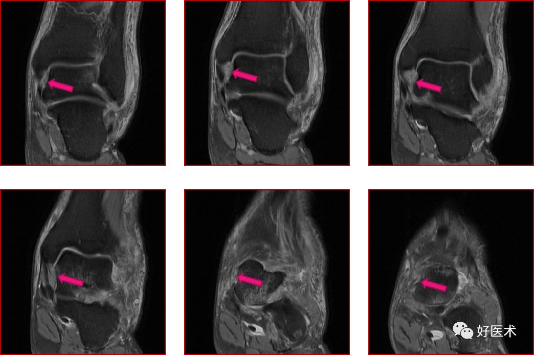 踝关节MRI解剖与常见病变-46