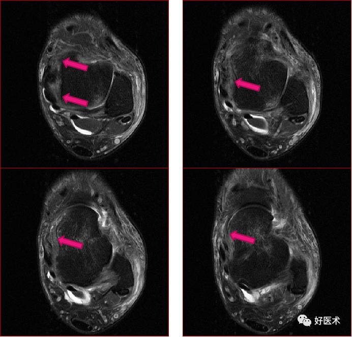 踝关节MRI解剖与常见病变-47