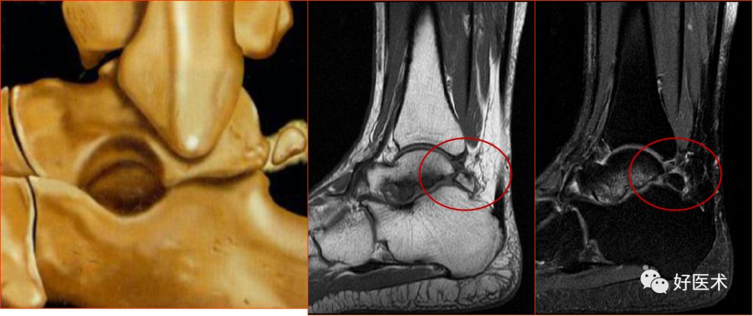 踝关节MRI解剖与常见病变-48