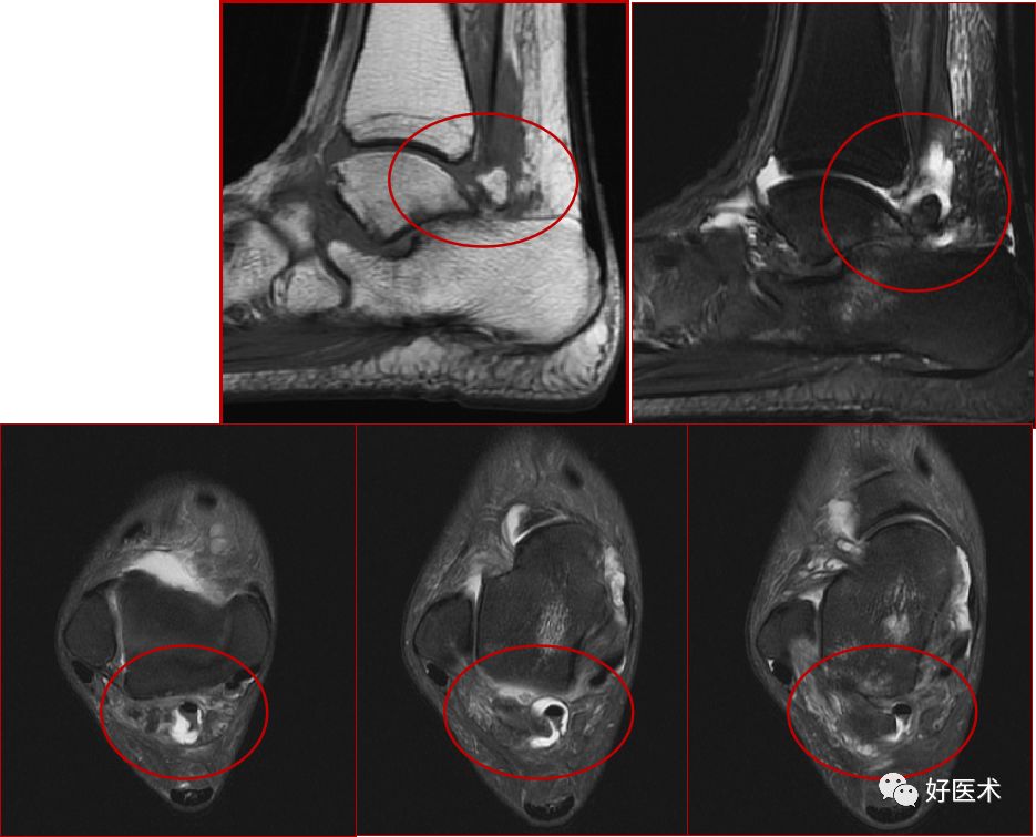 踝关节MRI解剖与常见病变-49