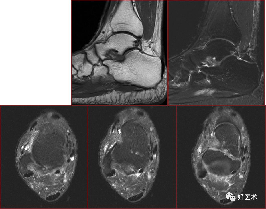 踝关节MRI解剖与常见病变-50