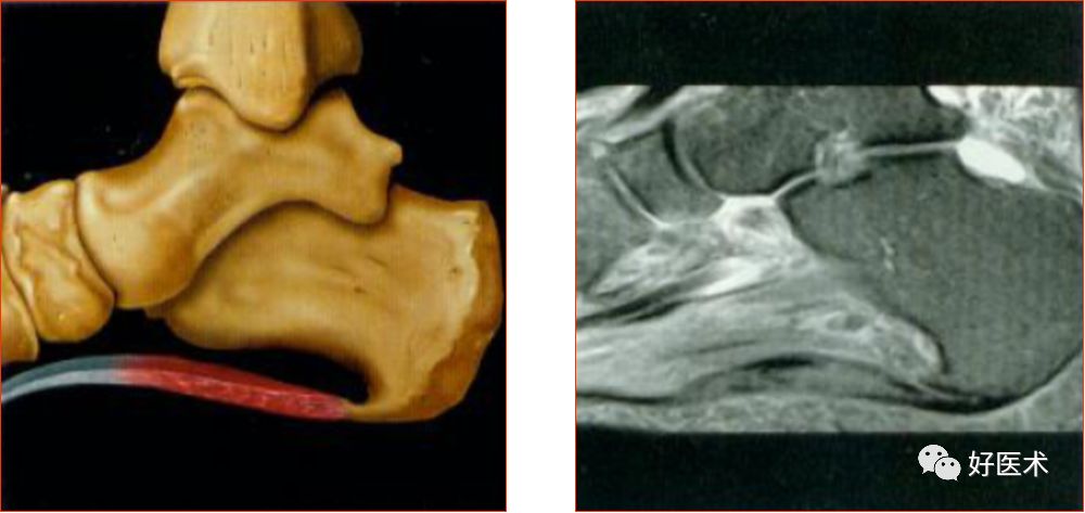 踝关节MRI解剖与常见病变-51